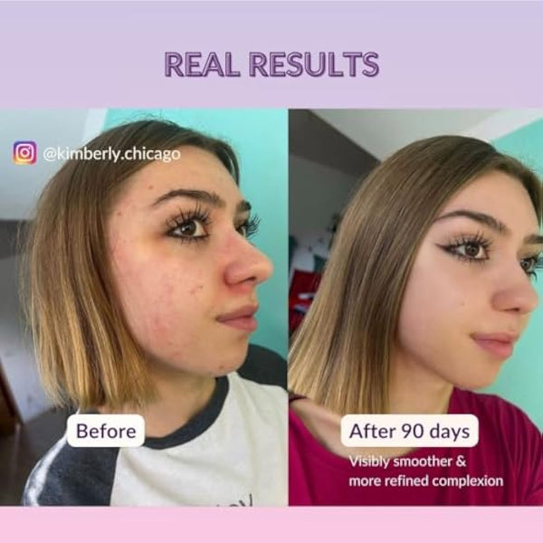 High Strength Retinol Serum - 2,5% Retinol Anti-Ageing Formula with Hyaluronic Acid and Witch Hazel - 30ml - Intensive Face Care against Wrinkles and Age Spots