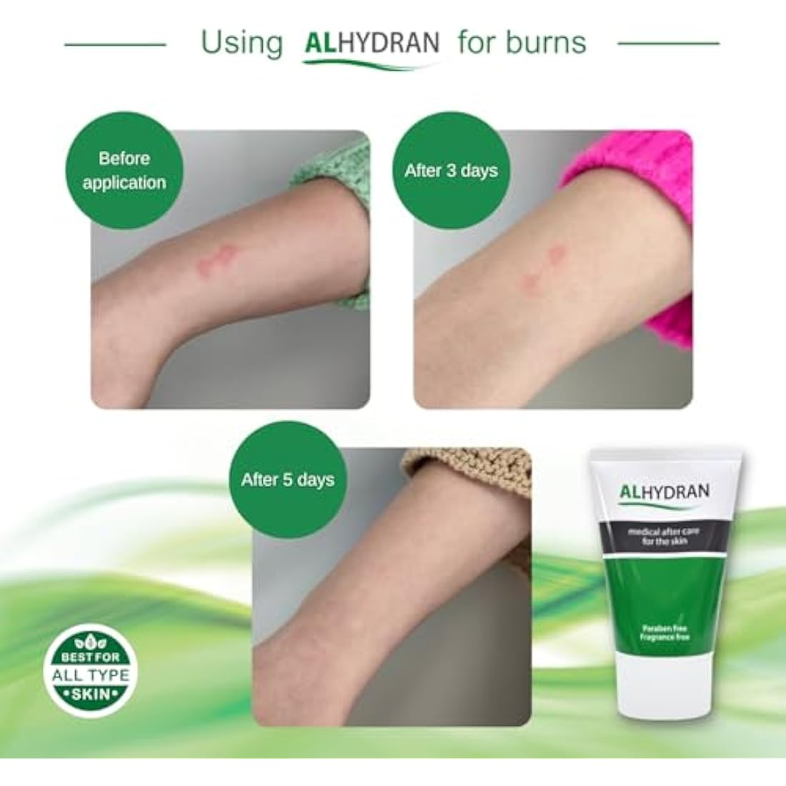 Alhydran After Care for The Skin | Scars, Dry Skin, Eczema, Itching, Burn Wounds and Skin Problems After Radiotherapy or Surgery,30 ml