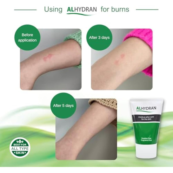 Alhydran After Care for The Skin | Scars, Dry Skin, Eczema, Itching, Burn Wounds and Skin Problems After Radiotherapy or Surgery,30 ml