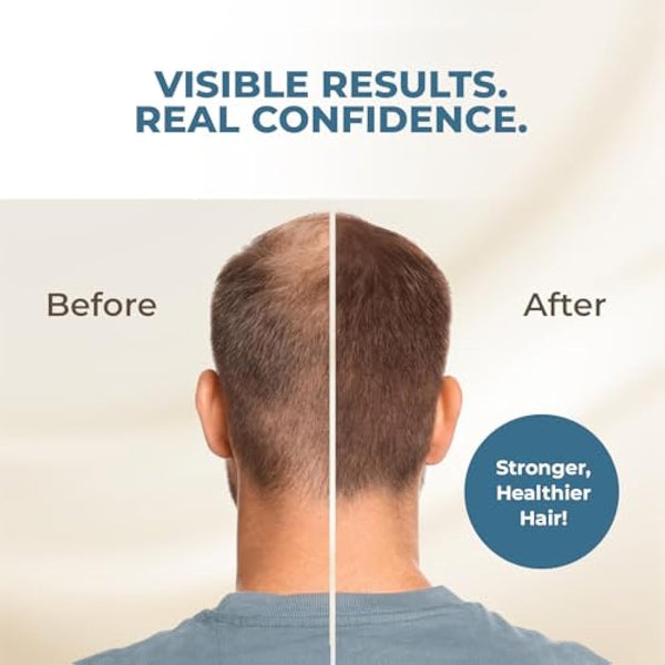 HAIRMETTO® Saw Palmetto Extract Pumpkin Seed Oil for Hair Growth - Hair Oil for Dry Scalp - 10X Potency Targeted Scalp Treatment with Castor, Lavender Scent, Rosemary Oil for Hair 4oz (118ml)