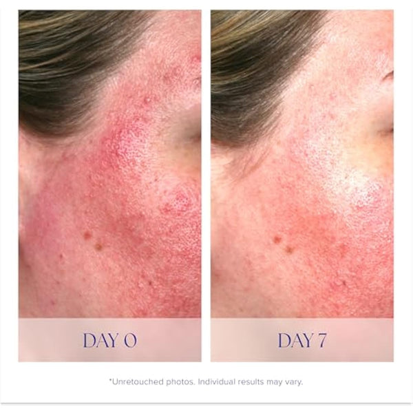 iS Clinical Pro-Heal Serum Advance+ antioxidant-rich serum containing vitamin C, E, and A for redness, rosacea, inflammation, 1 Fl Oz