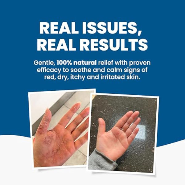 Grahams Natural Skin Therapy Body Oil - For Dry Skin, Eczema & Itch Relief - Hydrates & Nourishes Sensitive Skin - Natural 100% Oil Blend with Vitamin E | Hypoallergenic & Steroid-Free (220ml)