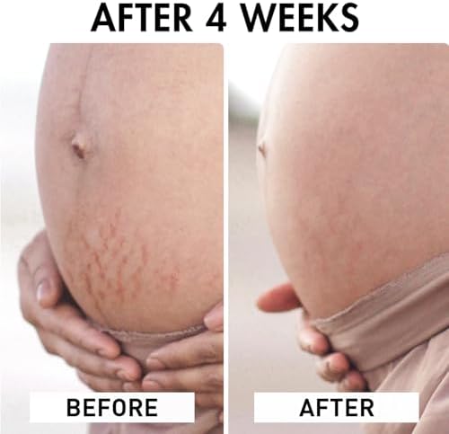 Organic Body Oil - Roll-on Massage - 100% Natural Ingredients and Vegan - Prevents and Reduces Stretch Marks - Improves Skin Elasticity - Nourishing and non-Sticky - Orange Blossom Scent - 100ml