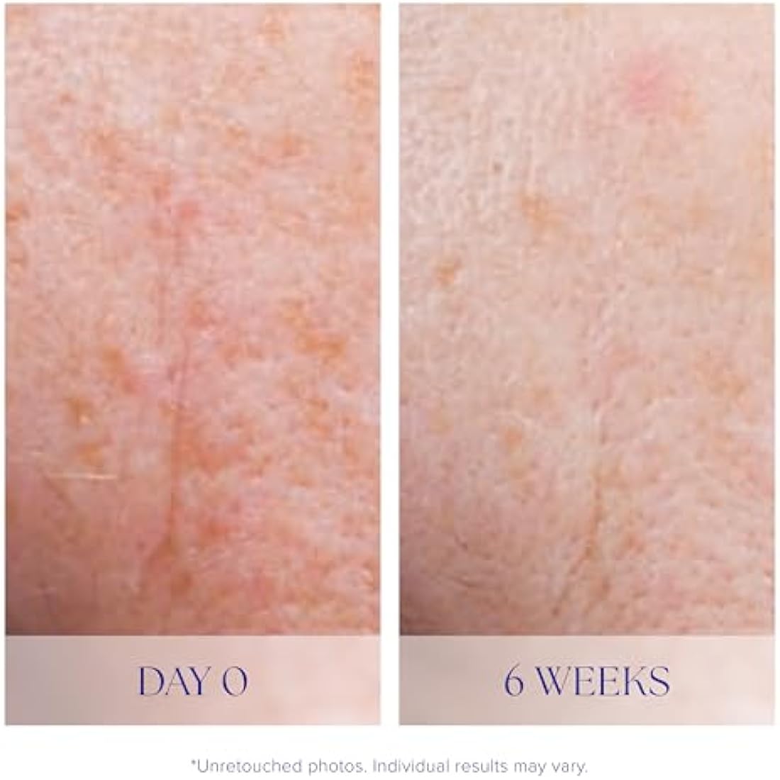 iS CLINICAL Active Serum - Visibly evens skin tone, Excellent for blemish prone skin, Anti-Aging Face Serum (0.5 Fl Oz)