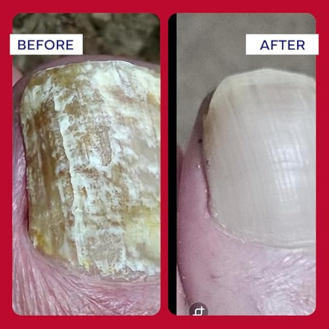 EMUAIDMAX Concentrate Homeopathic First Aid Serum, All Natural Solution for Itchy, Painful Skin Conditions, Targets Psoriasis, Eczema, Folliculitis, Nail Fungus, Seborrheic Dermatitis, 1 oz