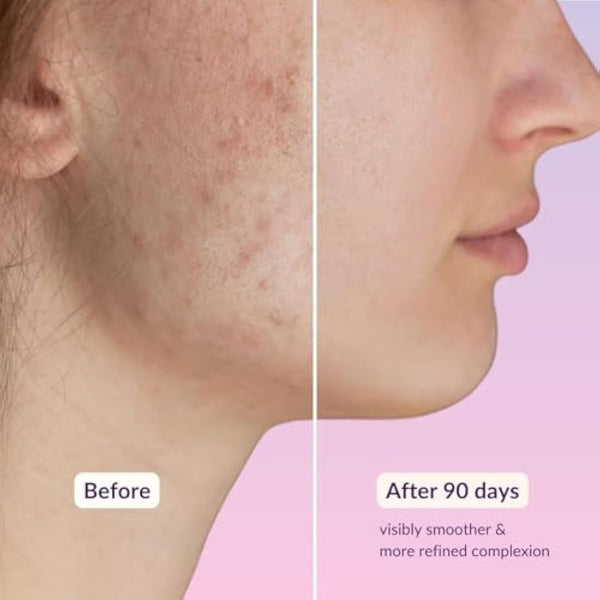 High Strength Retinol Serum - 2,5% Retinol Anti-Ageing Formula with Hyaluronic Acid and Witch Hazel - 30ml - Intensive Face Care against Wrinkles and Age Spots