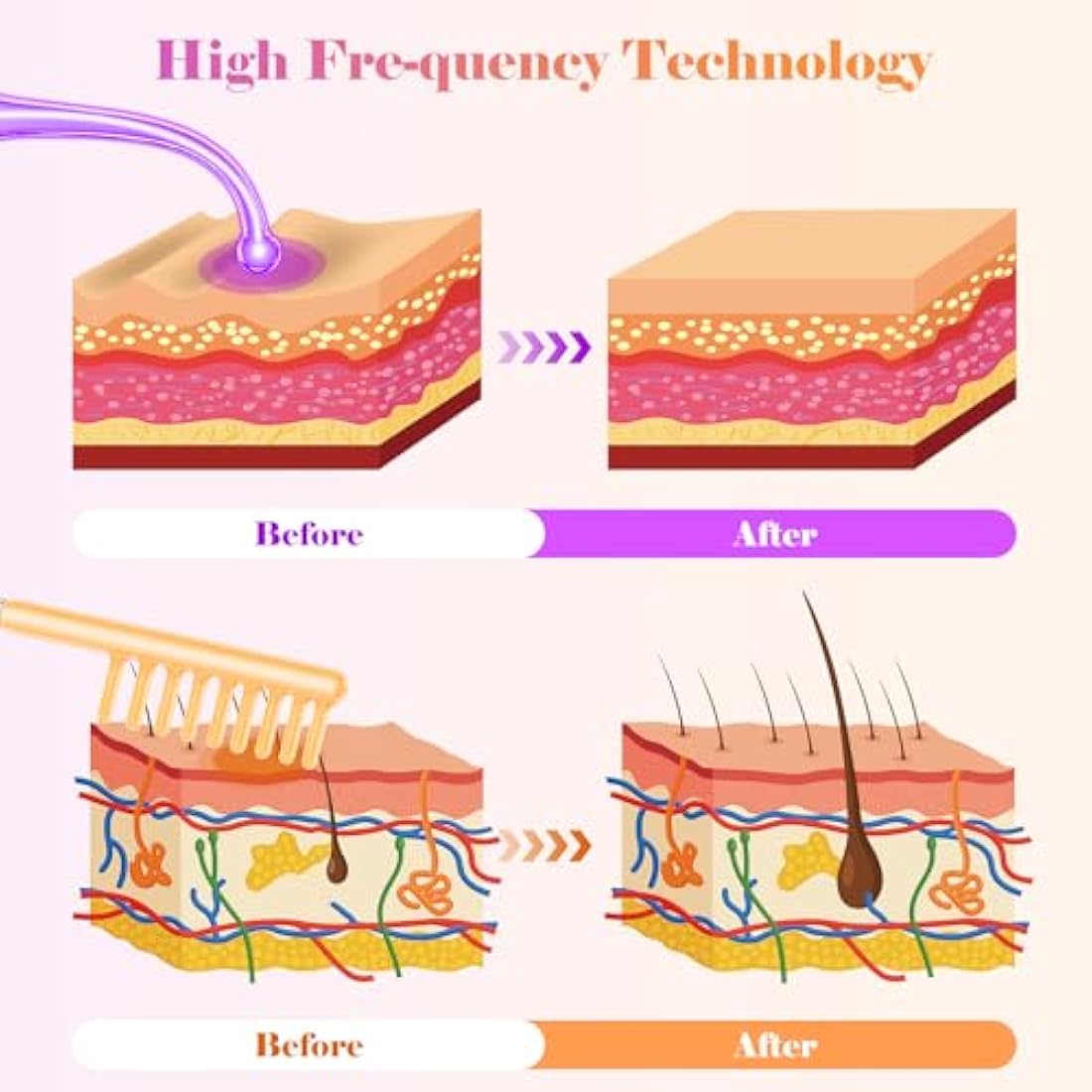 High F-requency Wand, iklestar High F-requency Facial Machine for Hair Growth with 6 Glass Tubes, Handheld Hair Wand Kit for Home Use