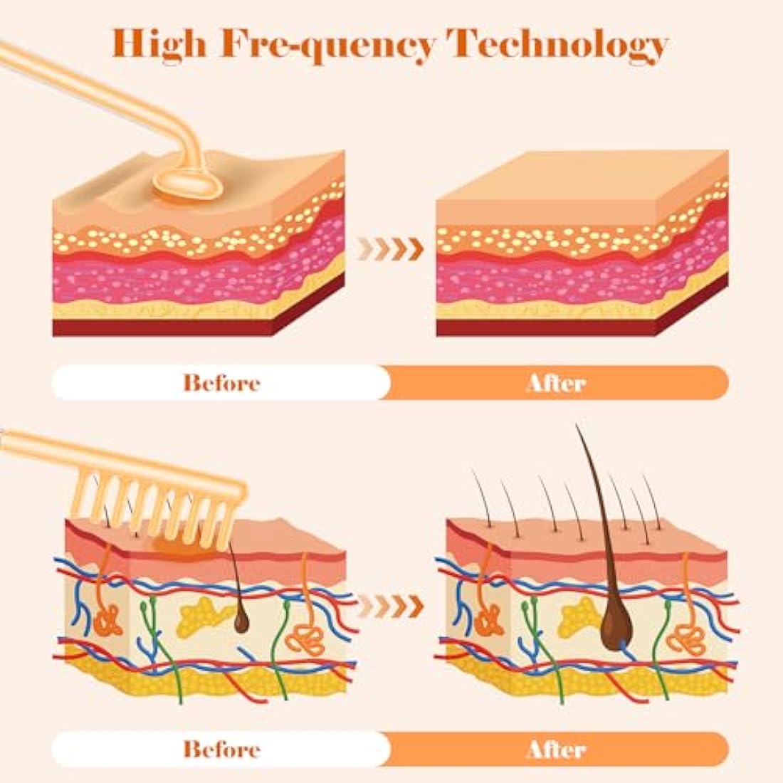 High F-requency Wand for Hair Growth, iklestar 6 PCS High F-requency Facial Machine Kit for Skin Care Home Salon Use