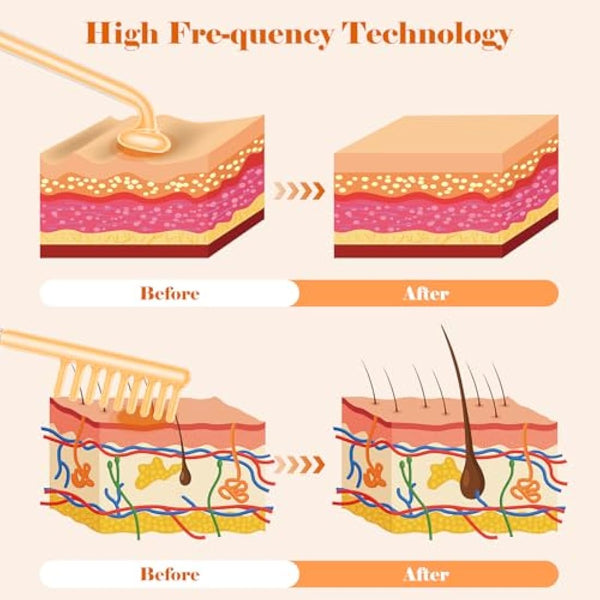 High F-requency Wand for Hair Growth, iklestar 6 PCS High F-requency Facial Machine Kit for Skin Care Home Salon Use