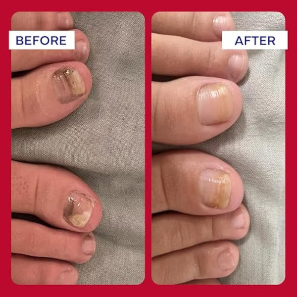 EMUAIDMAX Concentrate Homeopathic First Aid Serum, All Natural Solution for Itchy, Painful Skin Conditions, Targets Psoriasis, Eczema, Folliculitis, Nail Fungus, Seborrheic Dermatitis, 1 oz