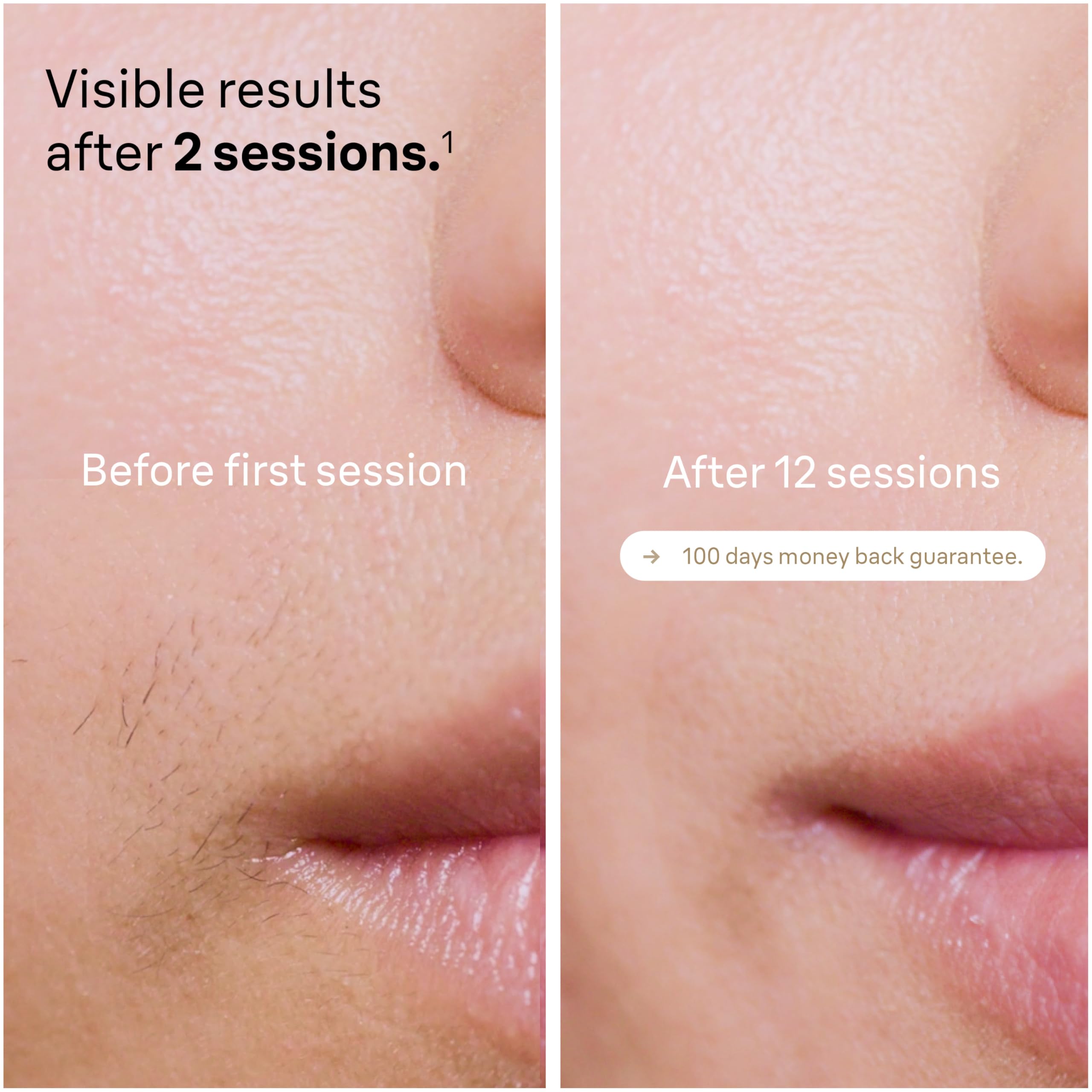 Braun IPL Silk-Expert Pro 5, at Home Hair Removal, Alternative for Laser Hair Removal, Includes Pouch, Venus Razor, Precision Head, 2 Years of Smooth Skin, Gift for Women, White/Gold, PL5137