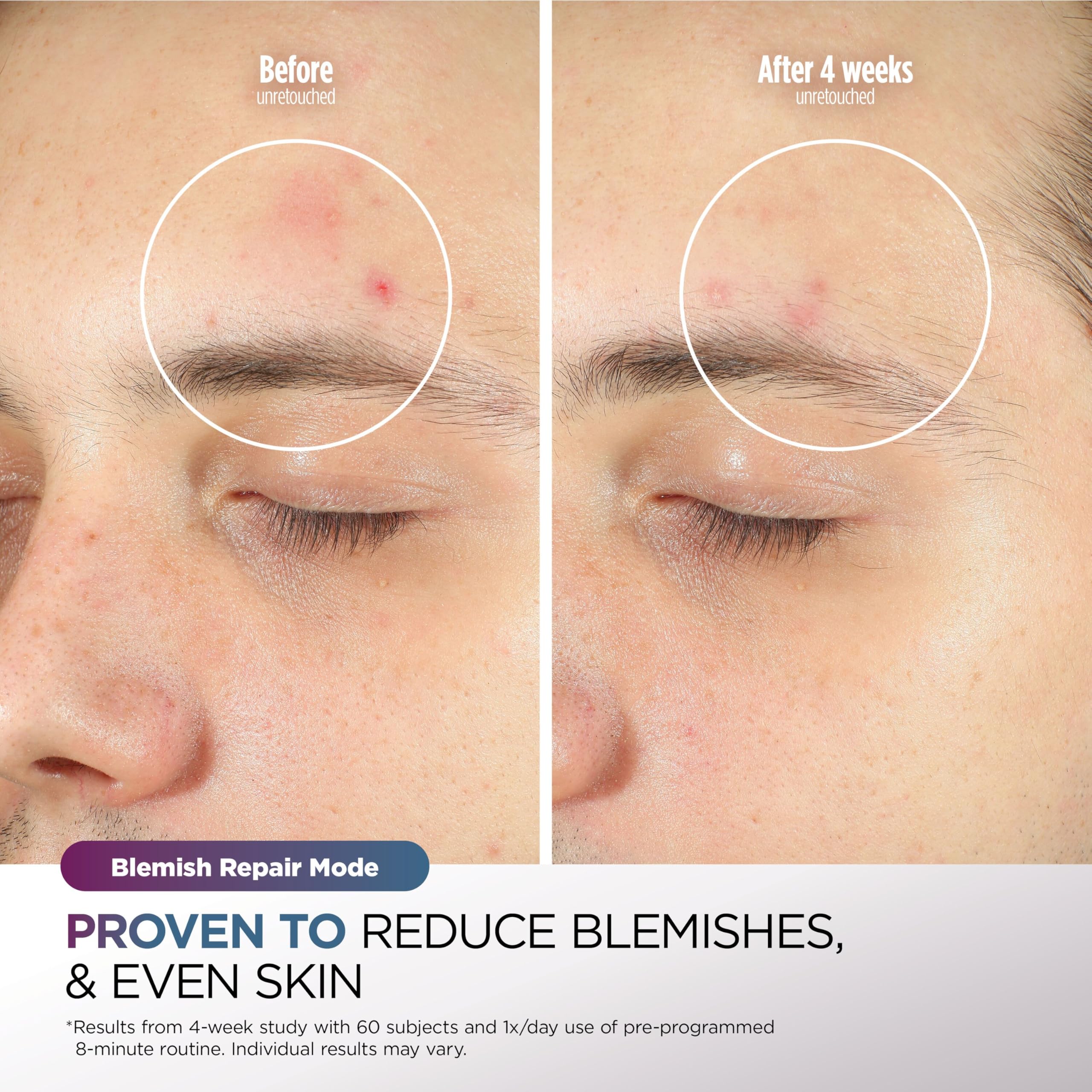 Shark CryoGlow LED Face Mask with Under-Eye Cooling, Anti-Ageing & Blemish Repair, Red & Blue LED, Infrared Light Therapy, USB-C, Remote Control, Storage Bag, Adjustable Straps